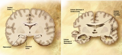 Az agy sorvadása Alzeimer-kórban