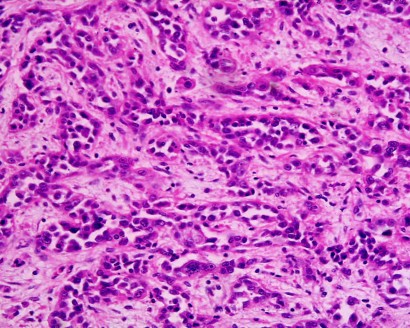 Adenocarcinoma