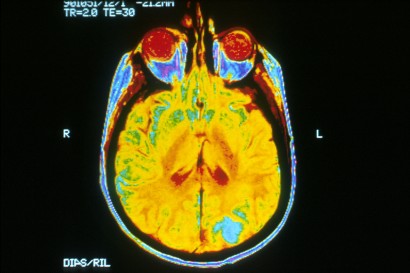 Az agy MRI-képe