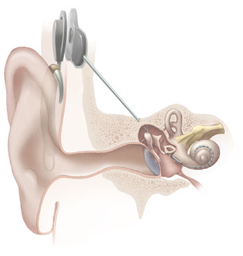 Cochleáris implantátum